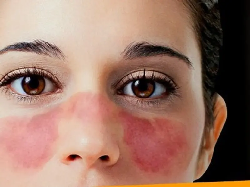 Lupus / FOTO (Flickr)