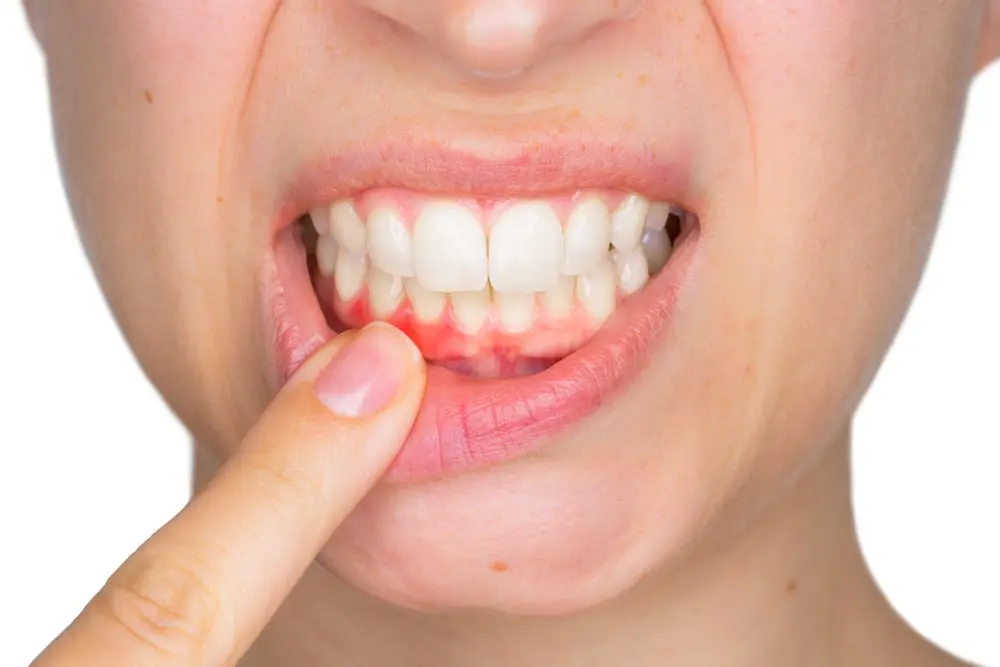Mejora los casos de gingivitis (inflamación de las encías)