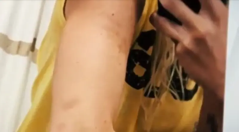 Las heridas que mostró Frida Sofía (@SueltaLaSopaTV)