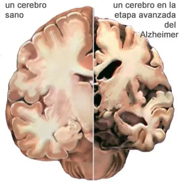 FOTO: Alzheimer's Association