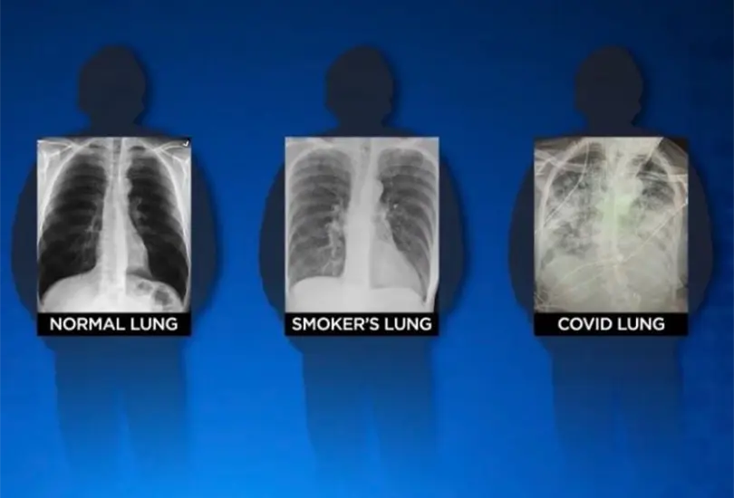 Pulmones post-Covid quedan más dañados que los de un fumador Pulmones post-Covid quedan más dañados que los de un fumador
