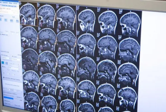 Qué es un infarto cerebral y cuáles son las señales de alerta Qué es un infarto cerebral y cuáles son las señales de alerta