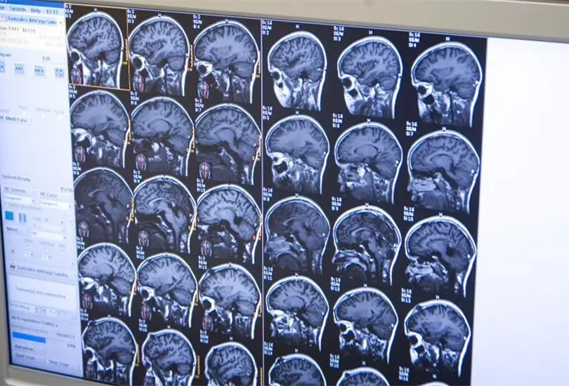 Qu&eacute; es un infarto cerebral y cu&aacute;les son las se&ntilde;ales de alerta