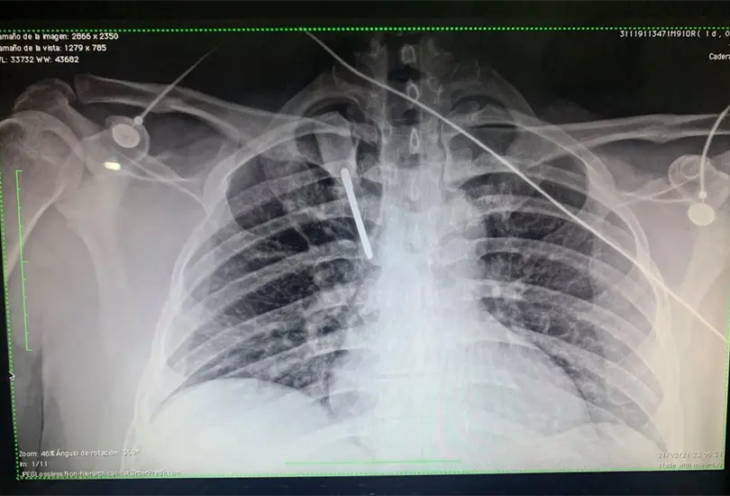A médico le encajan un desarmador en el pecho durante un asalto A médico le encajan un desarmador en el pecho durante un asalto