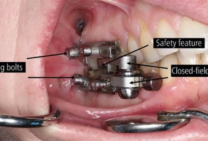 Desarrollan dispositivo para perder peso que impide que la boca se abra más de 2 mm Desarrollan dispositivo para perder peso que impide que la boca se abra más de 2 mm