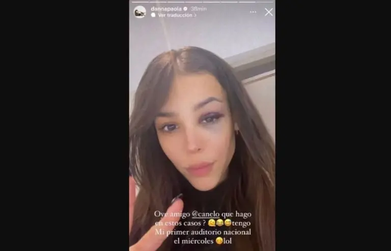 El moretón en el ojo de Danna Paola. Foto: Instagram (dannapaola).