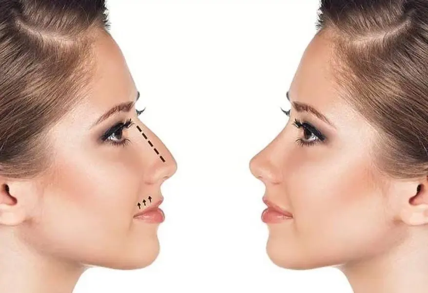 Fueron realizadas 852,554 cirugías estéticas de este tipo. 