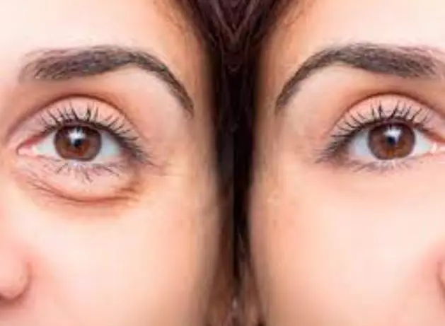 Se realizaron 1,225,540 de este tipo de cirugía que extirpa el exceso de piel de los párpados.