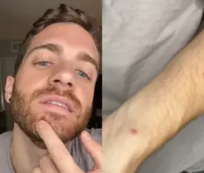 “Es horrible”: Tiktoker narra su experiencia al contraer viruela del mono |VIDEO