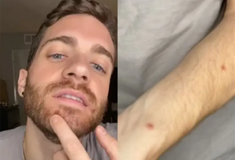 El actor estadounidense Matt Ford contó su experiencia al contagiarse de la viruela del mono Créditos: Captura de video El actor estadounidense Matt Ford contó su experiencia al contagiarse de la viruela del mono Créditos: Captura de video