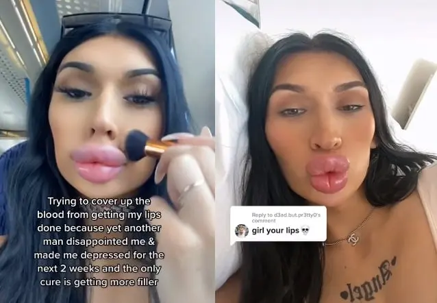 Mujer se rellena los labios tras recibir un rechazo sentimental