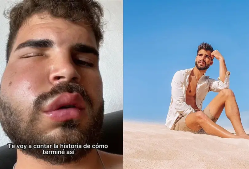 Dani Schepers cont&oacute; que comenz&oacute; a hincharse luego de acudir a un dentista para que le sacaran una muela