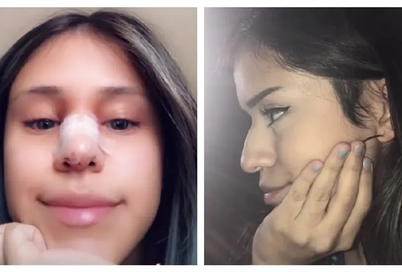Perdona infidelidad cambio de una cirug&iacute;a de nariz 