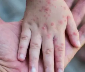 Gripe del tomate: qué es y cuáles son los síntomas de la enfermedad que afecta a niñas y niños