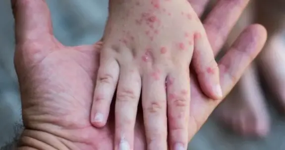 La gripe del tomate afecta principalmente a niños menores de 5 años Créditos: Especial La gripe del tomate afecta principalmente a niños menores de 5 años Créditos: Especial