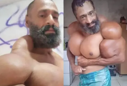 El ´hulk´ brasileño murió víctima de un paro cardiaco ocasionado por las inyecciones de ´synthol´ Créditos:Especial El ´hulk´ brasileño murió víctima de un paro cardiaco ocasionado por las inyecciones de ´synthol´ Créditos:Especial