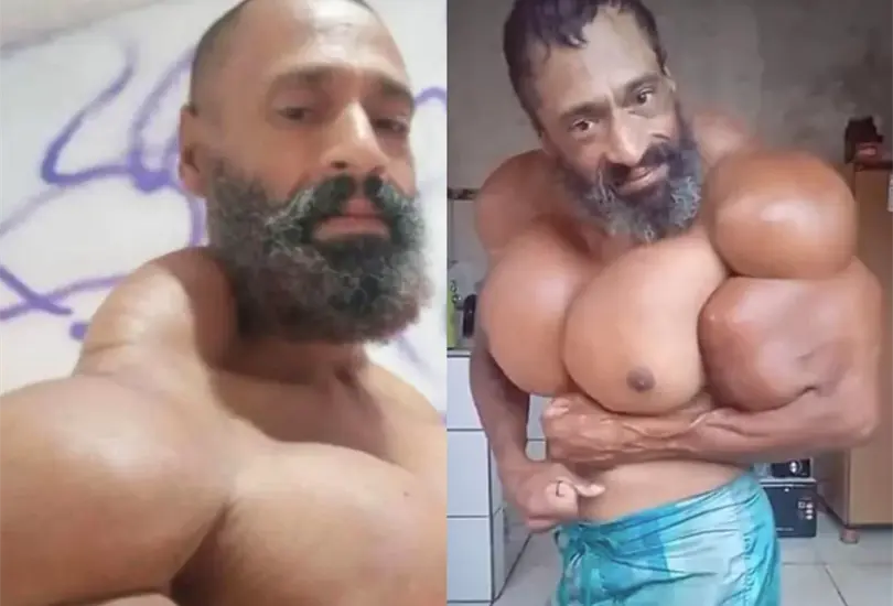 El ´hulk´ brasileño murió víctima de un paro cardiaco ocasionado por las inyecciones de ´synthol´ Créditos:Especial El ´hulk´ brasileño murió víctima de un paro cardiaco ocasionado por las inyecciones de ´synthol´ Créditos:Especial