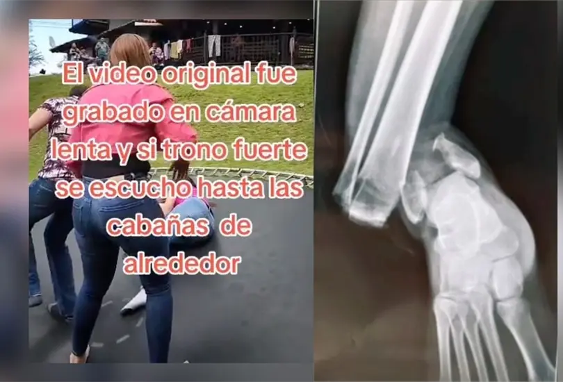 Impactante momento en que una mujer se rompe el pie por saltar en trampol&iacute;n 
