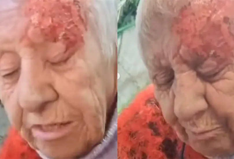 Una mujer de la tercera edad fue quemada con &aacute;cido por unos agresores que tambi&eacute;n mataron a sus perros