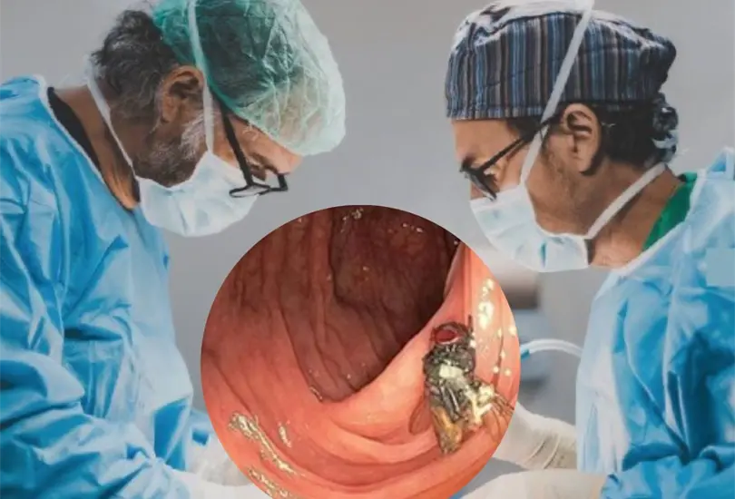 ¡Impactante descubrimiento! Encuentran una mosca viva en el intestino de un hombre ¡Impactante descubrimiento! Encuentran una mosca viva en el intestino de un hombre