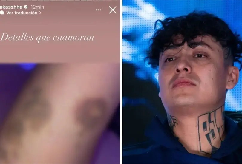 Akasha compartió fotografías que muestran moretones en brazos, manos y piernas. Akasha compartió fotografías que muestran moretones en brazos, manos y piernas.