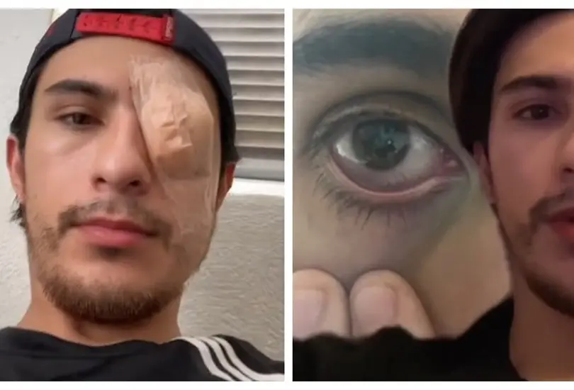 Joven pierde ojo por mal uso de lentes de contacto 