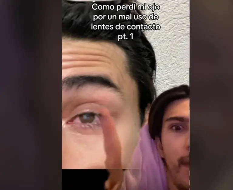 Joven pierde ojo por usar mal los lentes de contacto (TikTok)