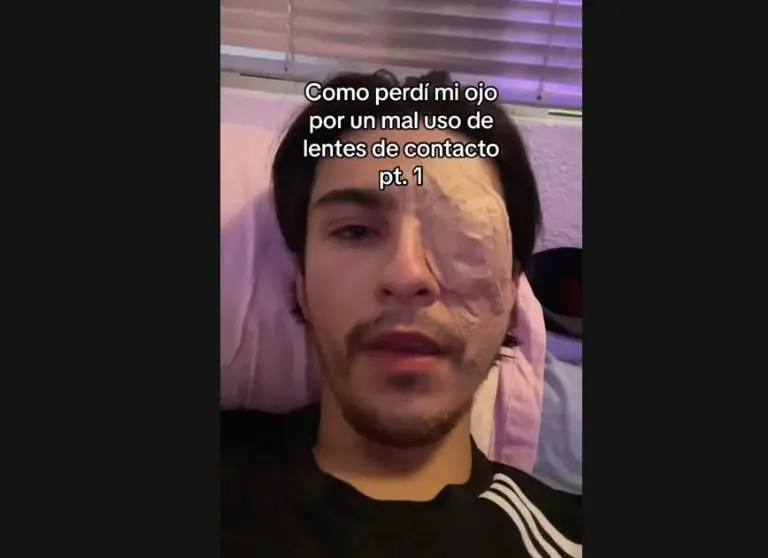 Joven pierde ojo por usar mal los lentes de contacto (TikTok)