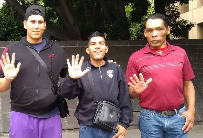 Acromegalia, una de las enfermedades más raras en México que no recibe apoyo. Acromegalia, una de las enfermedades más raras en México que no recibe apoyo.