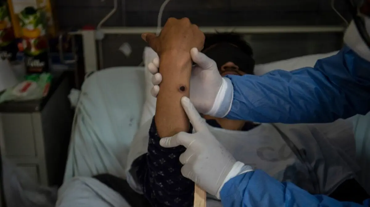 Aumentan casos de Mpox (viruela símica) Especial