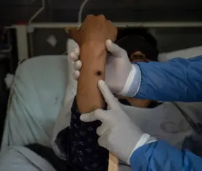 Emergencia mundial: confirman 49 casos de Mpox en México