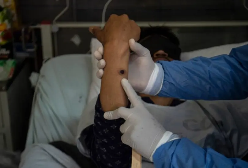 En México hay 49 casos activos de mpox, mejor conocida como la viruela del mono En México hay 49 casos activos de mpox, mejor conocida como la viruela del mono