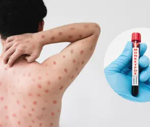 Viruela del Mono: ¿existe una vacuna en México para combatir el Mpox?