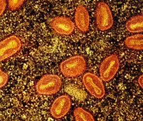 Mpox: ¿En qué estados de México se han reportado más contagios?