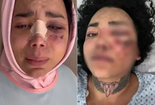 Paola Suárez de Las Perdidas rompe el silencio tras brutal golpiza de su novio. 