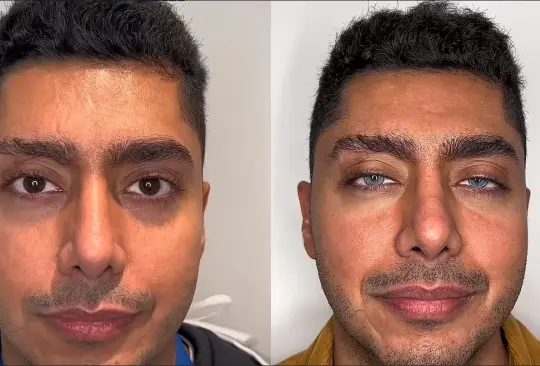¿Qué es la queratopigmentación ocular?: una peligrosa cirugía para cambiar el color de los ojos está en tendencia ¿Qué es la queratopigmentación ocular?: una peligrosa cirugía para cambiar el color de los ojos está en tendencia