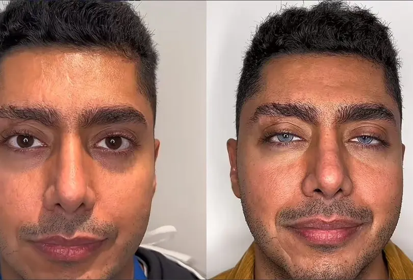 ¿Qué es la queratopigmentación ocular?: una peligrosa cirugía para cambiar el color de los ojos está en tendencia ¿Qué es la queratopigmentación ocular?: una peligrosa cirugía para cambiar el color de los ojos está en tendencia