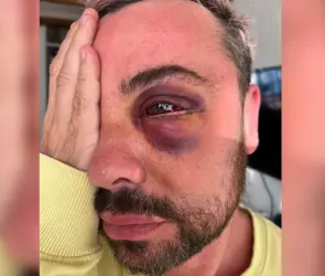 Actor de Televisa pierde la vista tras someterse a cirugía estética