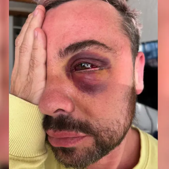 Actor de Televisa pierde la vista tras someterse a cirugía estética