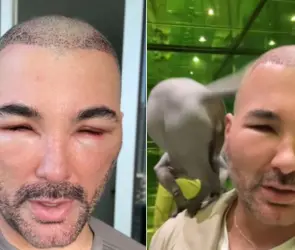 Actor de Televisa aparece desfigurado tras cirugía estética