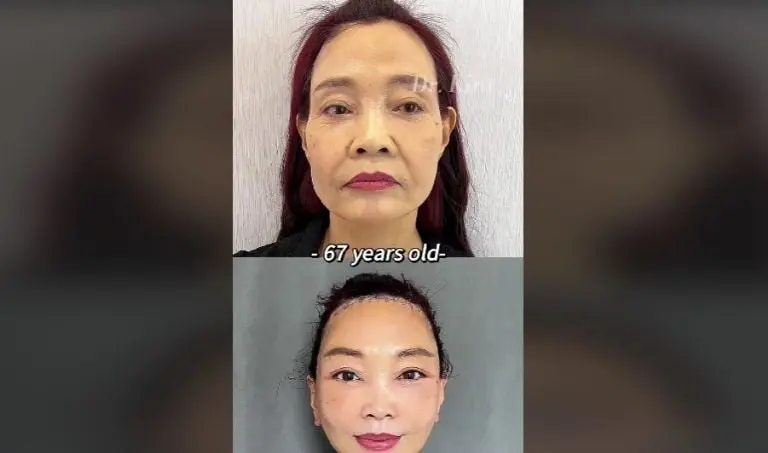 Paciente del Dr. Kim (TikTok)