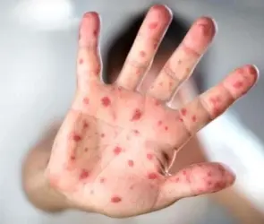 Alerta Nacional por contagios de sarampión, ¿cuántos casos hay en la CDMX?