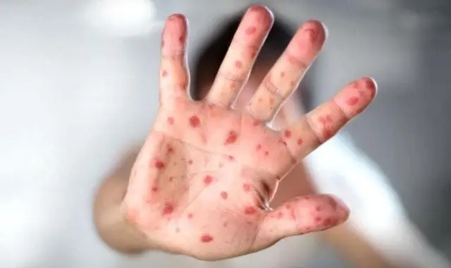 Alerta Nacional por contagios de sarampi&oacute;n, &iquest;cu&aacute;ntos casos hay en la CDMX?