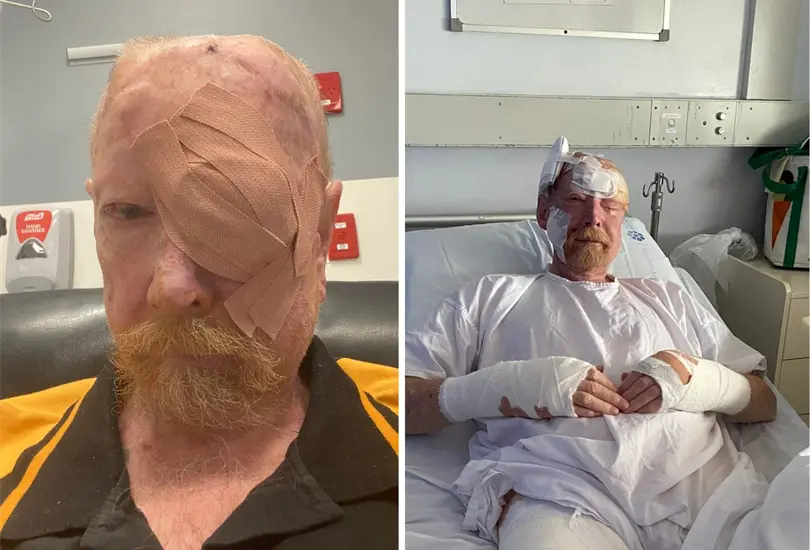 Leigh Raaschou ha sido tratado por casi 200 tipos de c&aacute;ncer de piel que le han dejado heridas, principalmente en la cabeza. 