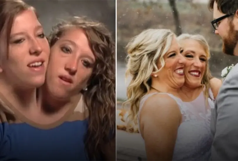 Las hermanas saltaron a la fama internacional por tener dos cabezas y compartir un cuerpo. Las hermanas saltaron a la fama internacional por tener dos cabezas y compartir un cuerpo.