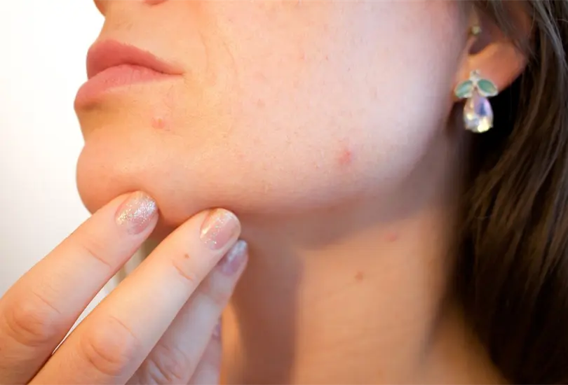 Se detectaron altos niveles de benceno, una sustancia asociada con riesgo de c&aacute;ncer, en tratamientos para el acn&eacute;. 