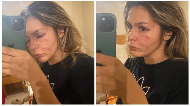 Así quedo el rostro de Brianda tras la pelea con Khelif en 2022.