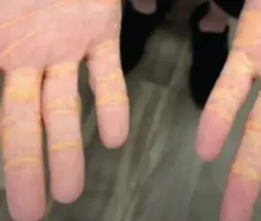 Colesterol sale por las manos de hombre que comi&oacute; grasa por meses