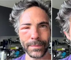 Osvaldo Benavides preocupa a fans al aparecer con el rostro desfigurado