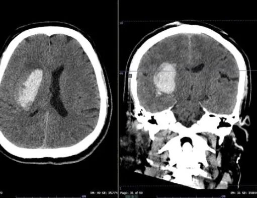 En la muerte cerebral, el cerebro deja de funcionar de forma irreversible. Especial.
